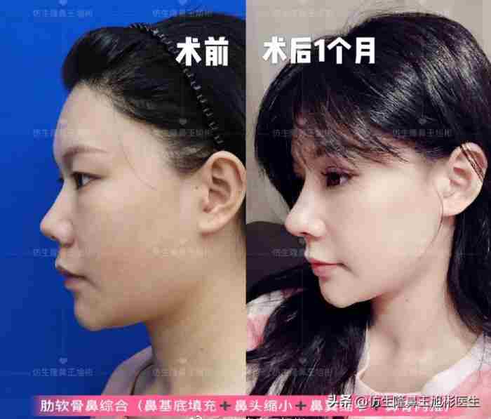 鼻子整形照片（华丽款鼻整形合集—并非人人适配）