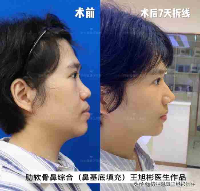 鼻子整形照片（华丽款鼻整形合集—并非人人适配）