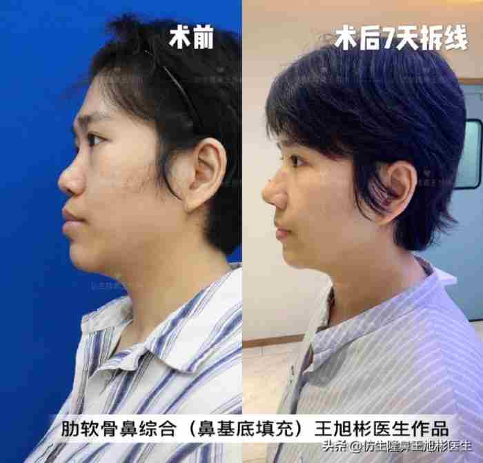 鼻子整形照片（华丽款鼻整形合集—并非人人适配）